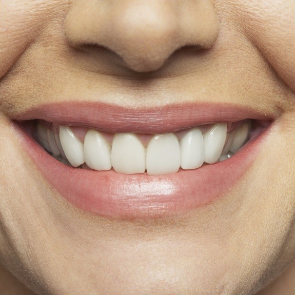 Closeup of healthy smile after virtual smile design