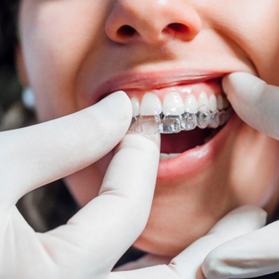 Dentist placing clear aligner on patient's teeth