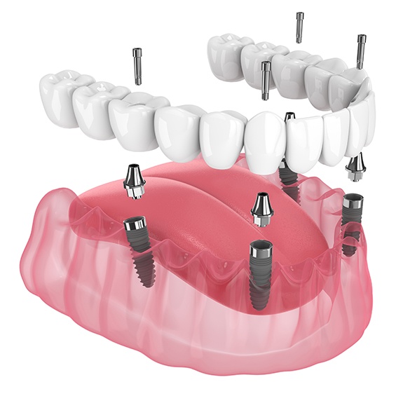 Illustration of All-on-4 dental implants for lower dental arch