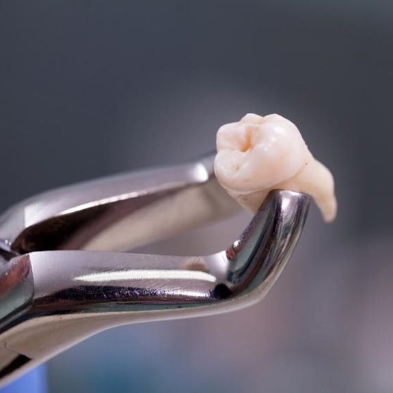 Metal clasp holding an extracted tooth